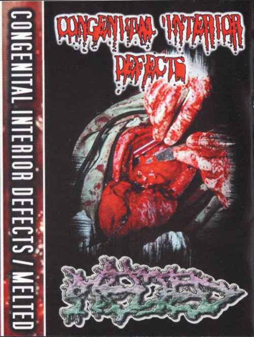 Congenital Interior Defects : Congenital Interior Defects - Melted Congenital Interior Defects : Congenital Interior Defects - Melted